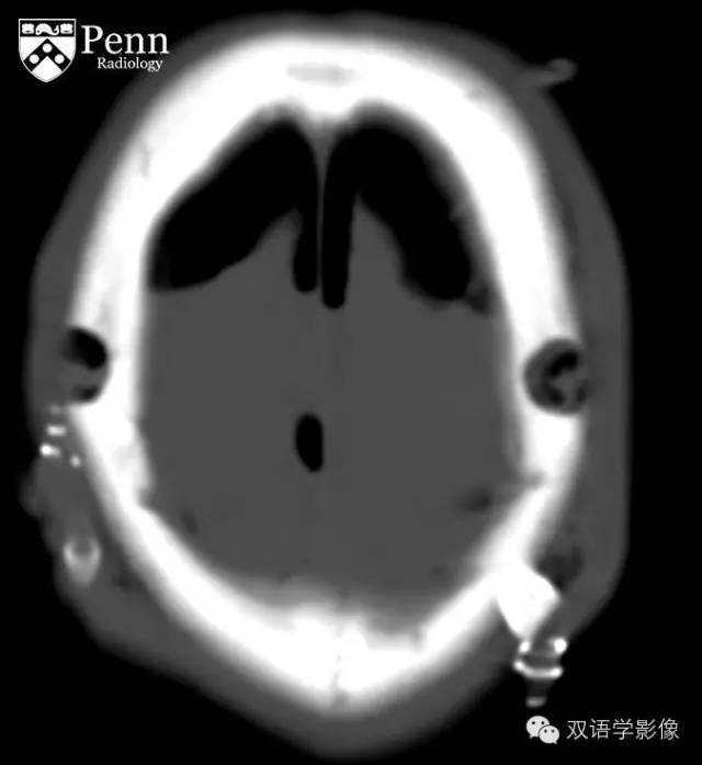 【双语病例】张力性气颅