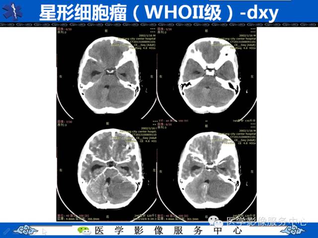 【病例学习】右额叶低级别星形细胞瘤1例MR影像表现