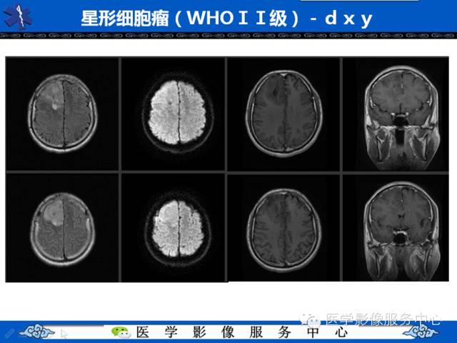 【病例学习】右额叶低级别星形细胞瘤1例MR影像表现