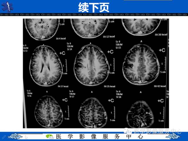 【病例学习】右额叶低级别星形细胞瘤1例MR影像表现