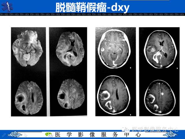 【病例学习】右额叶低级别星形细胞瘤1例MR影像表现