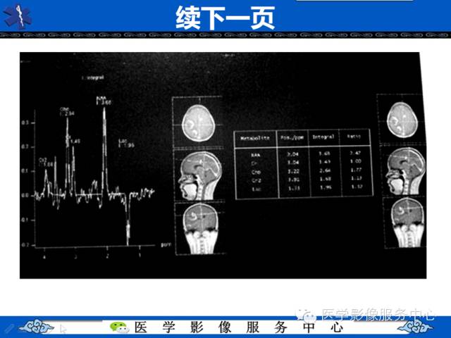 【病例学习】右额叶低级别星形细胞瘤1例MR影像表现