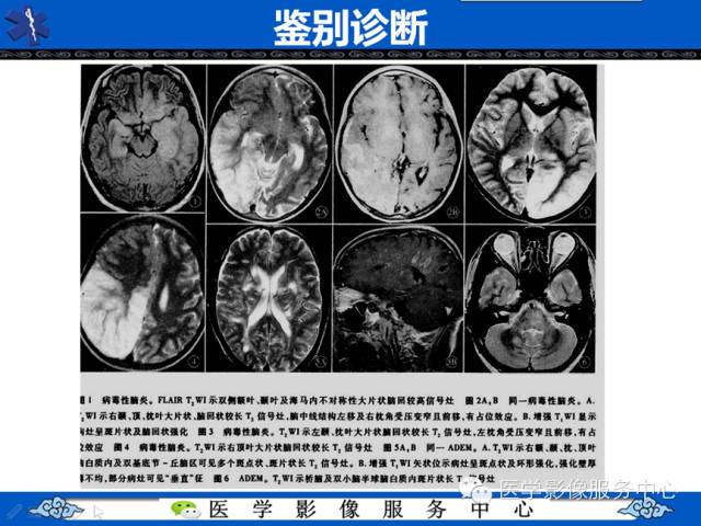 【病例学习】右额叶低级别星形细胞瘤1例MR影像表现