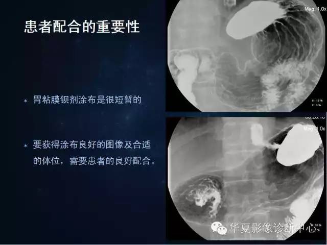 胃双对比造影技术简述