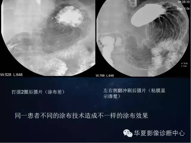 胃双对比造影技术简述