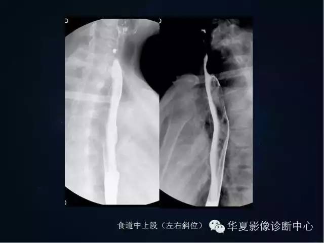 胃双对比造影技术简述