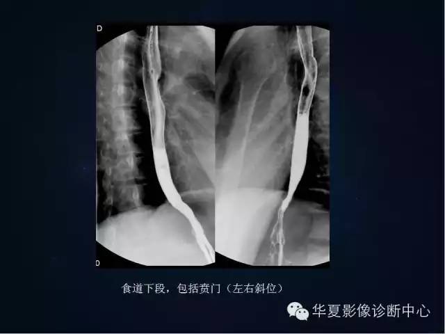 胃双对比造影技术简述