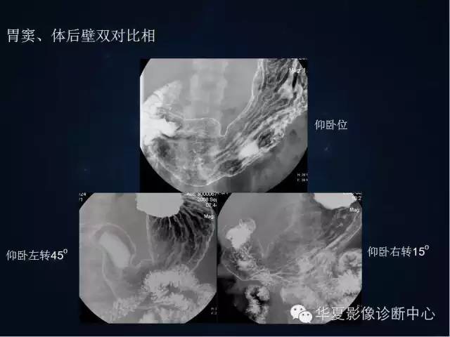 胃双对比造影技术简述