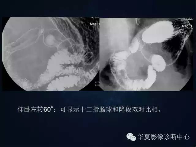 胃双对比造影技术简述