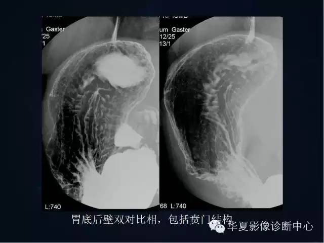 胃双对比造影技术简述