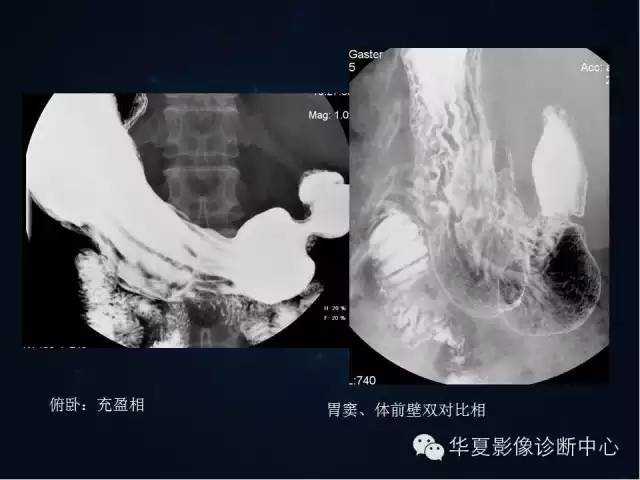 胃双对比造影技术简述