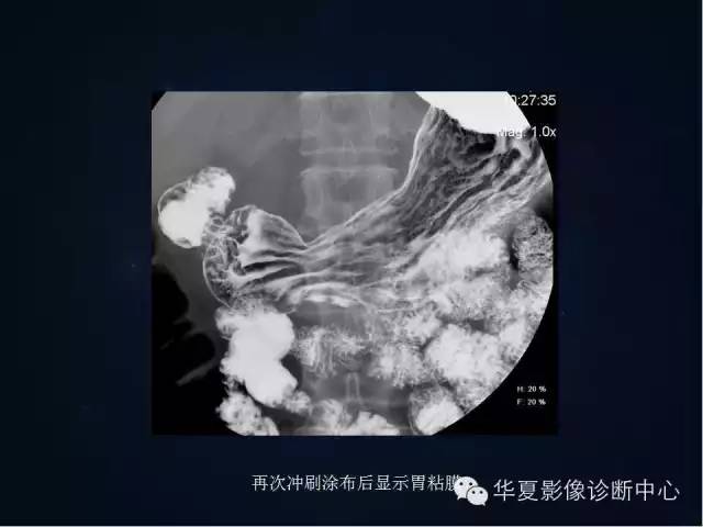 胃双对比造影技术简述