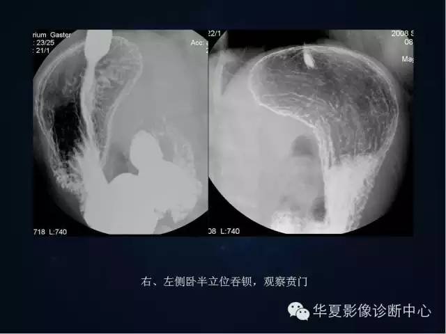 胃双对比造影技术简述