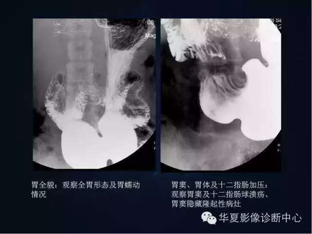 胃双对比造影技术简述