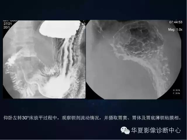 胃双对比造影技术简述