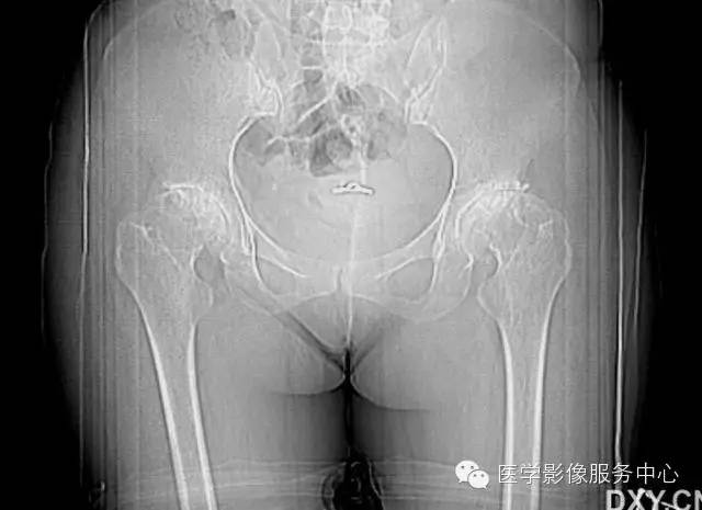 【病例学习】大骨节病1例影像表现