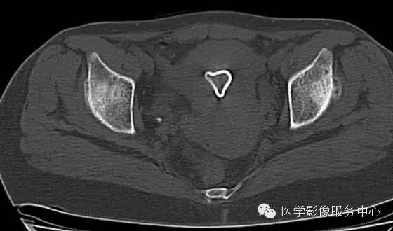 【病例学习】大骨节病1例影像表现 【病例学习】大骨节病1例影像表现