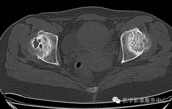【病例学习】大骨节病1例影像表现 【病例学习】大骨节病1例影像表现