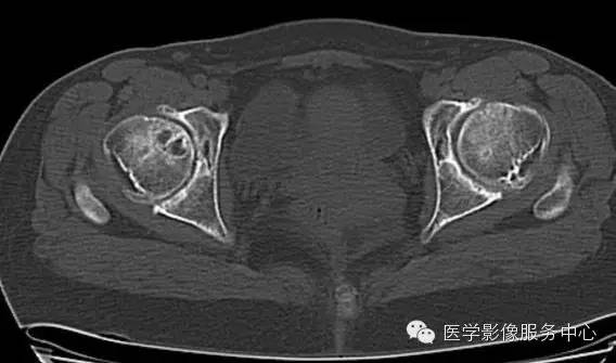 【病例学习】大骨节病1例影像表现 【病例学习】大骨节病1例影像表现