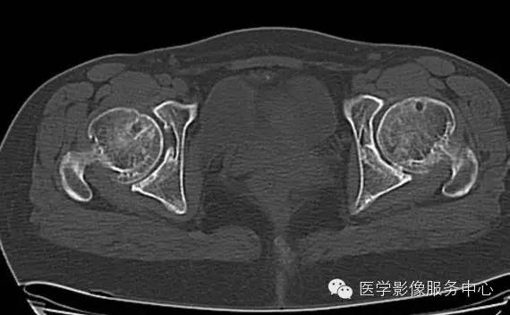 【病例学习】大骨节病1例影像表现 【病例学习】大骨节病1例影像表现