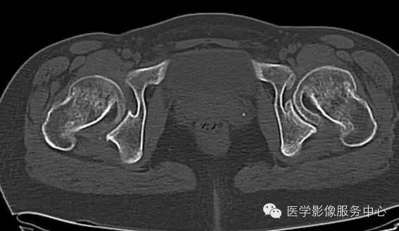 【病例学习】大骨节病1例影像表现 【病例学习】大骨节病1例影像表现