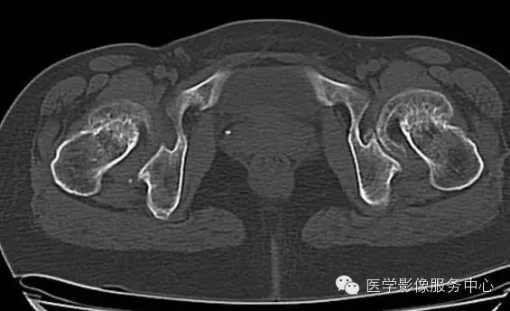 【病例学习】大骨节病1例影像表现 【病例学习】大骨节病1例影像表现