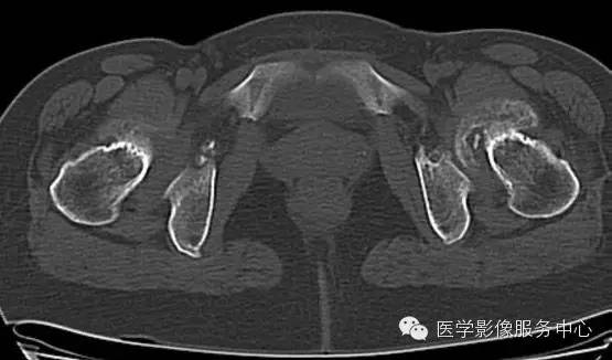 【病例学习】大骨节病1例影像表现 【病例学习】大骨节病1例影像表现