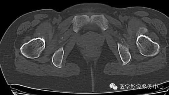【病例学习】大骨节病1例影像表现 【病例学习】大骨节病1例影像表现