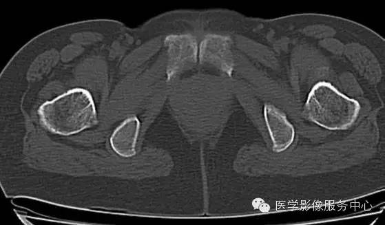 【病例学习】大骨节病1例影像表现 【病例学习】大骨节病1例影像表现