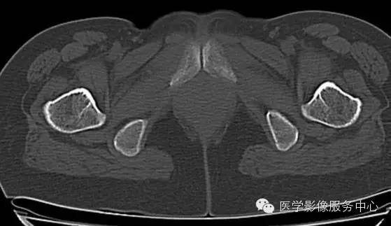 【病例学习】大骨节病1例影像表现 【病例学习】大骨节病1例影像表现