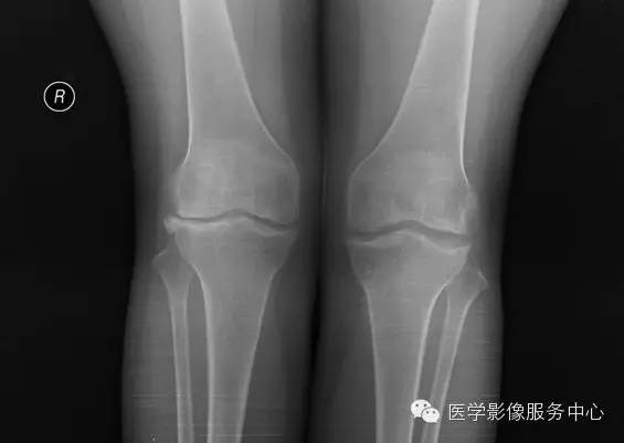 【病例学习】大骨节病1例影像表现 【病例学习】大骨节病1例影像表现
