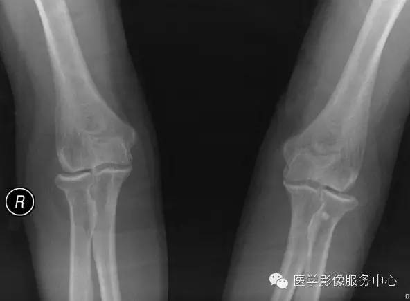 【病例学习】大骨节病1例影像表现 【病例学习】大骨节病1例影像表现