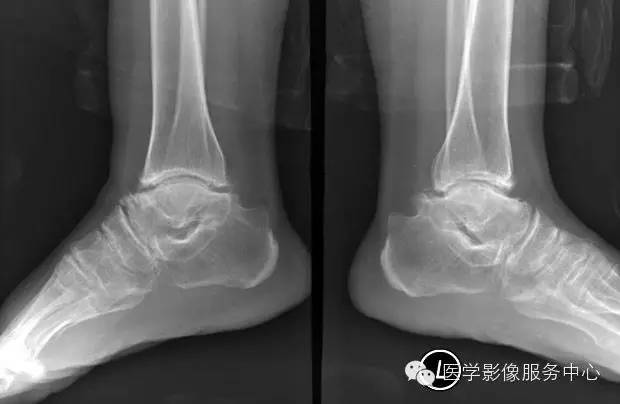【病例学习】大骨节病1例影像表现 【病例学习】大骨节病1例影像表现