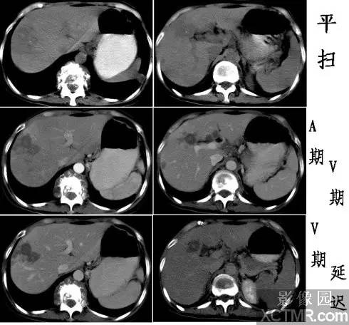 【病例学习】肝脏结核一例CT影像表现