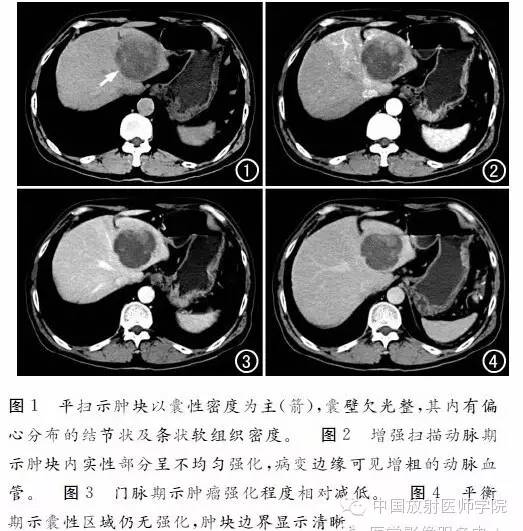 【病例】肝脏原发性癌肉瘤1例CT影像表现