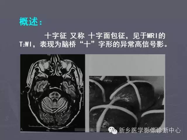 【PPT】关于“十”字征的经典总结