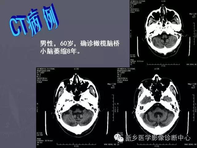 【PPT】关于“十”字征的经典总结