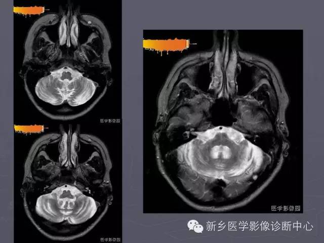 【PPT】关于“十”字征的经典总结