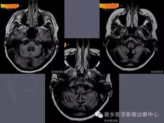 【PPT】关于“十”字征的经典总结