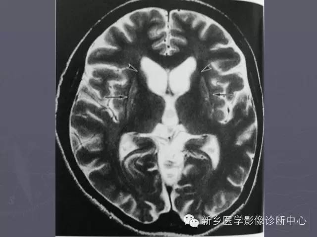 【PPT】关于“十”字征的经典总结