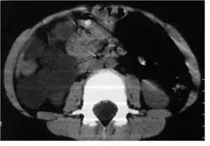 【病例】腹腔囊性淋巴管瘤1例CT影像表现
