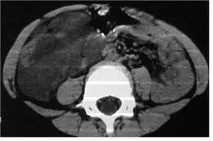 【病例】腹腔囊性淋巴管瘤1例CT影像表现