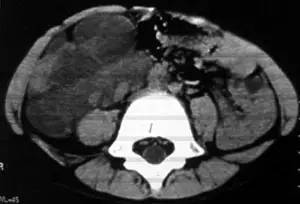 【病例】腹腔囊性淋巴管瘤1例CT影像表现