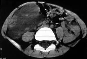 【病例】腹腔囊性淋巴管瘤1例CT影像表现