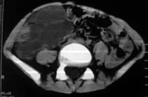 【病例】腹腔囊性淋巴管瘤1例CT影像表现