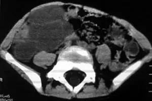 【病例】腹腔囊性淋巴管瘤1例CT影像表现