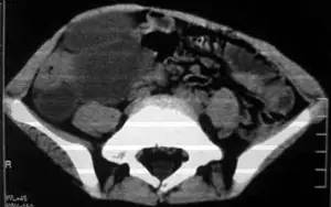【病例】腹腔囊性淋巴管瘤1例CT影像表现