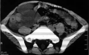 【病例】腹腔囊性淋巴管瘤1例CT影像表现