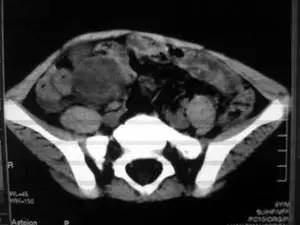 【病例】腹腔囊性淋巴管瘤1例CT影像表现