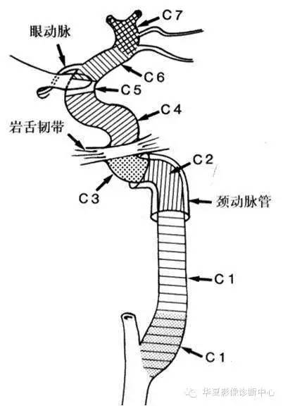 三张图让你记牢颈内动脉、椎动脉“最新”分段